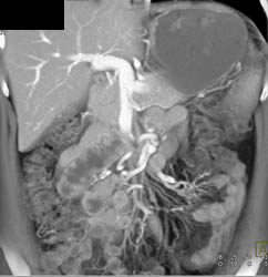 Hepatoma - CTisus CT Scan