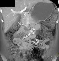 Portal Hypertension With Increased Flow Into Mesenteric Vessels - CTisus CT Scan