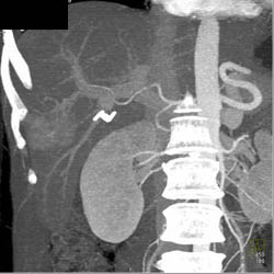 Focal Nodular Hyperplasia (FNH) - CTisus CT Scan