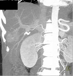 Focal Nodular Hyperplasia (FNH) - CTisus CT Scan