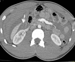 Liver Trauma With Active Bleed and Hemoperitoneum - CTisus CT Scan