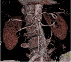 Celiac and SMA Arise From A Common Trunk - CTisus CT Scan