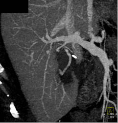 Active Bleed in Right Lobe of Liver - CTisus CT Scan