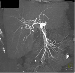 Celiac Stenosis - CTisus CT Scan