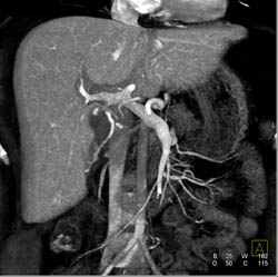 Portal Vein Infiltrated in Hilum - CTisus CT Scan