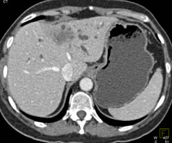 Cholangiocarcinoma - CTisus CT Scan