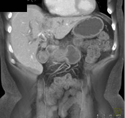 Cholangiocarcinoma - CTisus CT Scan