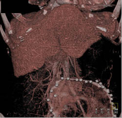 Liver Abscess - CTisus CT Scan