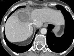 Liver Abscess - CTisus CT Scan