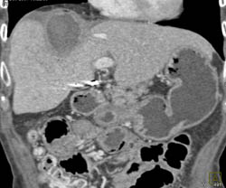 Liver Abscess - CTisus CT Scan