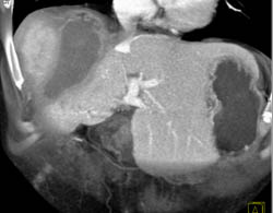 Liver Abscess - CTisus CT Scan