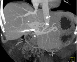 Liver Abscess - CTisus CT Scan