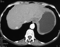 Focal Nodular Hyperplasia (FNH) - CTisus CT Scan