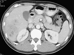 Liver Abscess - CTisus CT Scan