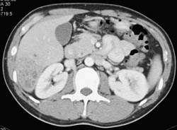 Liver Abscess - CTisus CT Scan