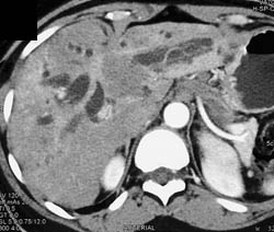 Cholangiocarcinoma With Dilated Ducts - CTisus CT Scan