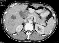 Liver Abscess - CTisus CT Scan