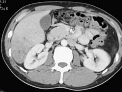 Liver Abscess - CTisus CT Scan