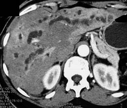 Central Cholangiocarcinoma With Dilated Common Bile Duct (CBD) - CTisus CT Scan