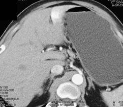 Hemangioma - CTisus CT Scan