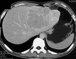 Hepatoma - CTisus CT Scan