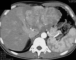 Hepatoma - CTisus CT Scan