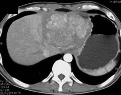 Hepatoma - CTisus CT Scan