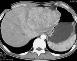 Hepatoma - CTisus CT Scan