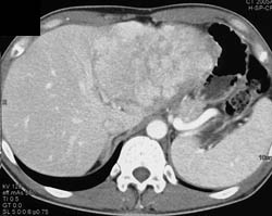 Hepatoma - CTisus CT Scan