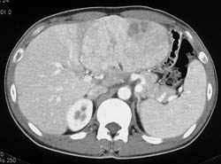 Hepatoma - CTisus CT Scan