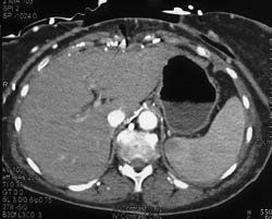 Hot Spot Liver Due to SVC Occlusion - CTisus CT Scan