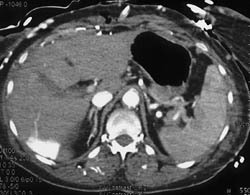 Hot Spot Liver Due to SVC Occlusion - CTisus CT Scan