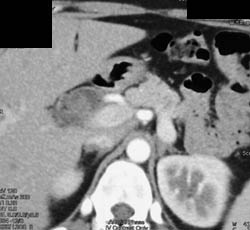 Tumor in Common Bile Duct - CTisus CT Scan