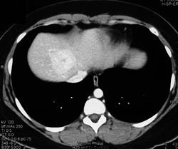 Focal Nodular Hyperplasia (FNH) - CTisus CT Scan