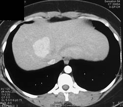 Focal Nodular Hyperplasia (FNH) - CTisus CT Scan