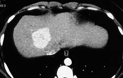 Focal Nodular Hyperplasia (FNH) - CTisus CT Scan