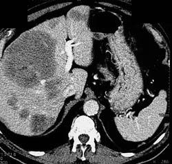 Liver Metastases - CTisus CT Scan