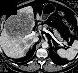 Liver Metastases - CTisus CT Scan