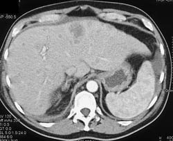 Liver Metastases - CTisus CT Scan