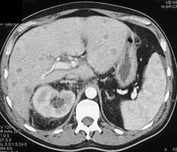 Liver Metastases - CTisus CT Scan