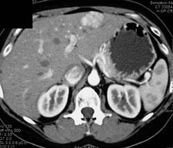 Focal Nodular Hyperplasia (FNH) - CTisus CT Scan