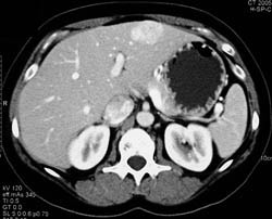 Focal Nodular Hyperplasia (FNH) - CTisus CT Scan