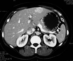 Focal Nodular Hyperplasia (FNH) - CTisus CT Scan