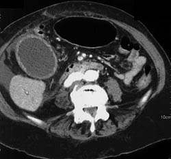 Acute Cholecystitis - CTisus CT Scan