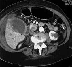 Acute Cholecystitis - CTisus CT Scan