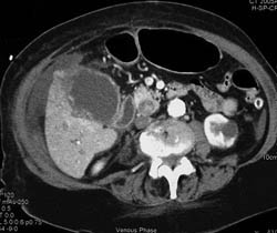 Acute Cholecystitis - CTisus CT Scan