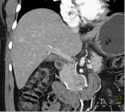 Focal Nodular Hyperplasia (FNH) - CTisus CT Scan