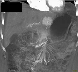 Focal Nodular Hyperplasia (FNH) - CTisus CT Scan