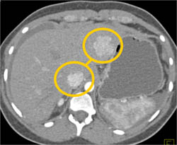 Focal Nodular Hyperplasia (FNH) - CTisus CT Scan