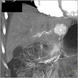 Focal Nodular Hyperplasia (FNH) - CTisus CT Scan